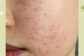 手机拍好多痘痘？手机拍照痘痘问题解决方法是什么？