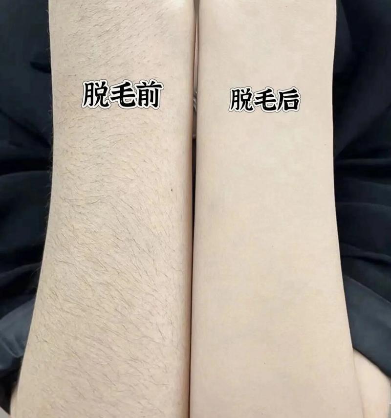 达到完美脱毛效果的最佳方法（掌握正确的脱毛技巧）  第1张